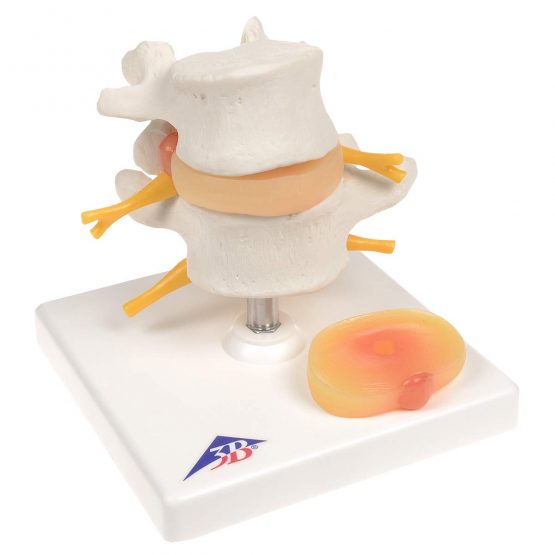 3B Scientific Lumbar Spinal Column with Prolapsed InterVertebral Disc + free anatomy software - 3B Smart Anatomy - Image 2