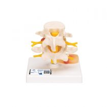 3B Scientific Lumbar Spinal Column with Prolapsed InterVertebral Disc + free anatomy software - 3B Smart Anatomy