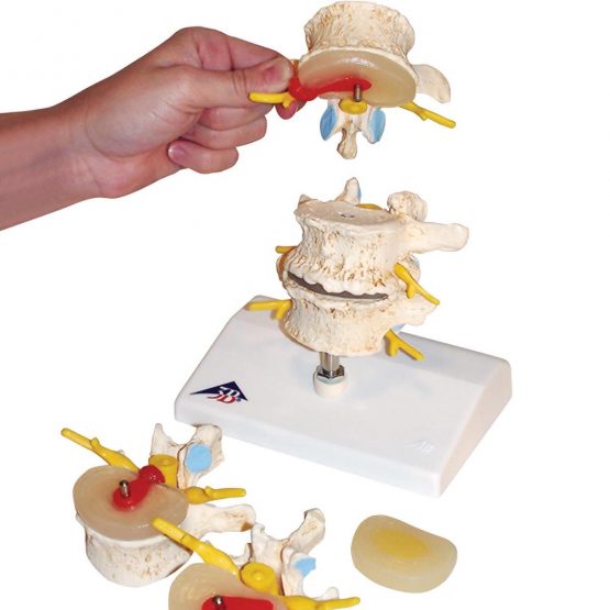 3B Scientific Stages of Disc prolapse and Vertebral Degeneration + free anatomy software - 3B Smart Anatomy A795 - Image 2