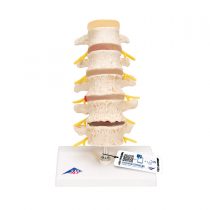 3B Scientific Stages of Disc prolapse and Vertebral Degeneration + free anatomy software - 3B Smart Anatomy A795