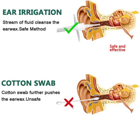 Ear Wax Removal Tool Kit, Ear Wax Remover Washer Bottle System for Ear ...