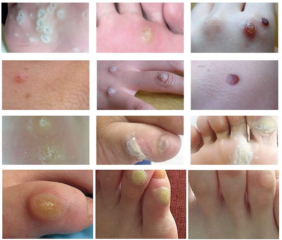 Wart Remover, Corn Complete Removal, Corn Remover, Foot Corn Remover Pads, Plantar Wart Removal - Image 3