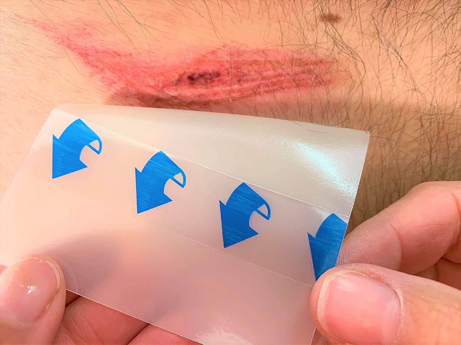 Hydrocolloid Thin Wound Dressing, Waterproof, Breathable & Adhesive Patches for Faster Healing Blister & Acne Protection - Image 4