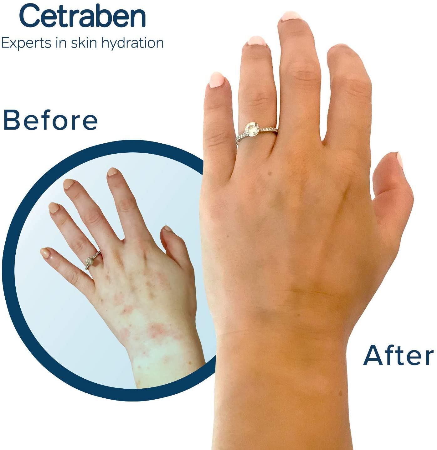 Cetraben Moisturising Cream, for Dry Itchy, Sensitive & Eczema-Prone Skin, Soothe, Moisturise, Hydrate, & Protect - Image 3