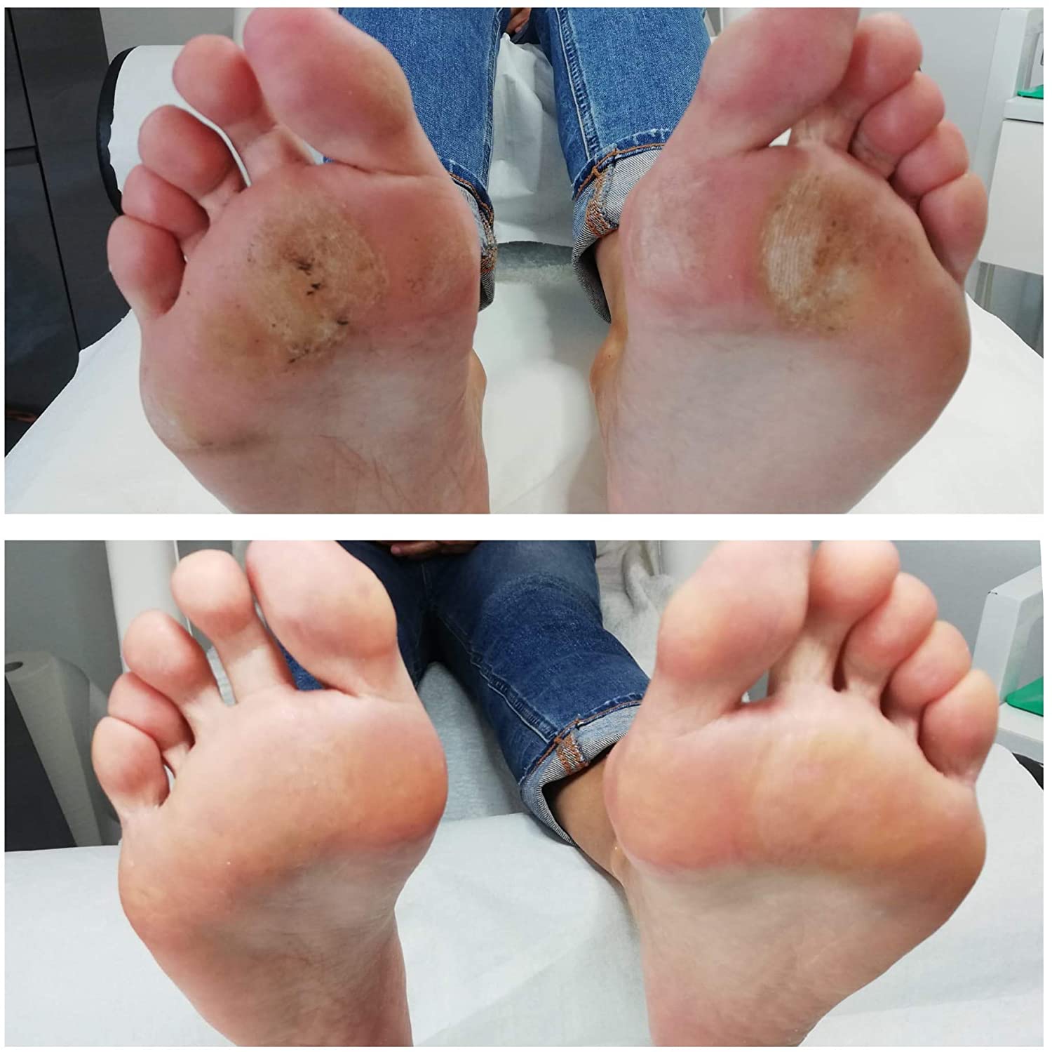 Ultra Effective Foot Callus Corn Remover with Salicylic Acid Foot