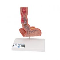 3B Scientific K18 Diseases of The Oesophagus + free anatomy software - 3B Smart Anatomy