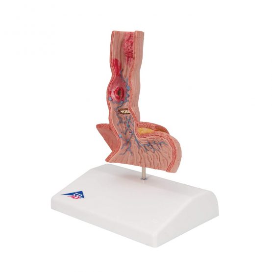 3B Scientific K18 Diseases of The Oesophagus + free anatomy software - 3B Smart Anatomy - Image 2