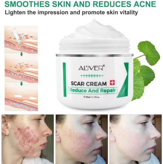 Scar Removal Cream For New and Old Scars,Stretch Mark Removal Gel Ointment, Multiuse Acne Scar