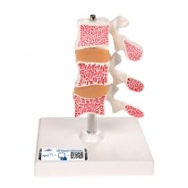 3B Scientific Deluxe Osteoporosis Model 3 Vertebrae + free anatomy software - 3B Smart Anatomy