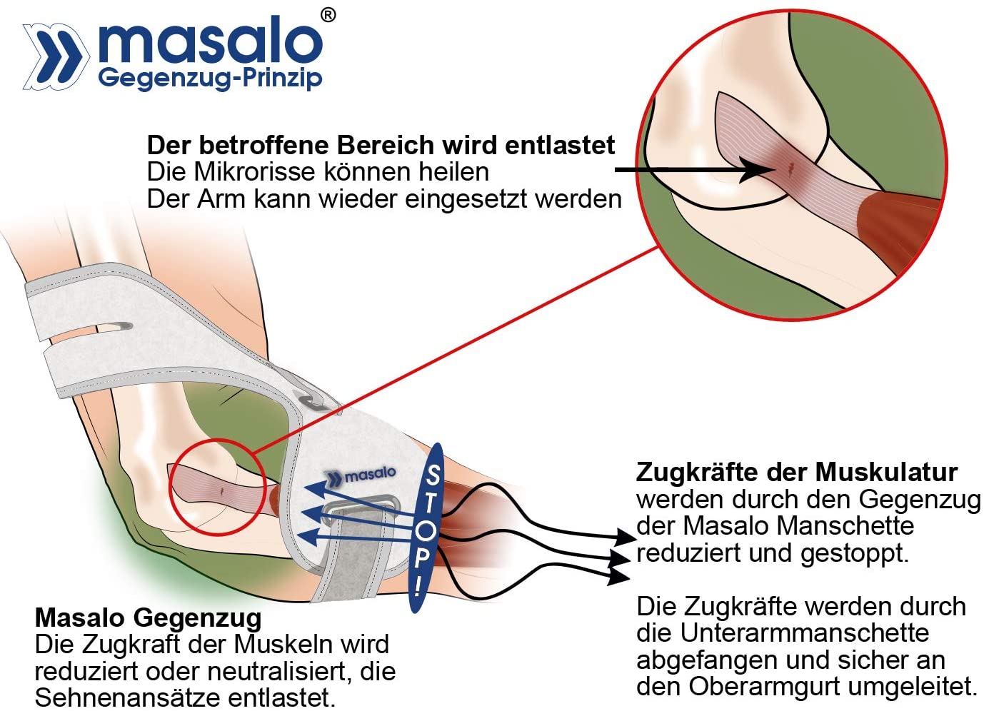 Masalo® Med cuff for tennis elbow golfer's arm, mouse arm (epicondylitis). 2R (1Right), gray - Image 2