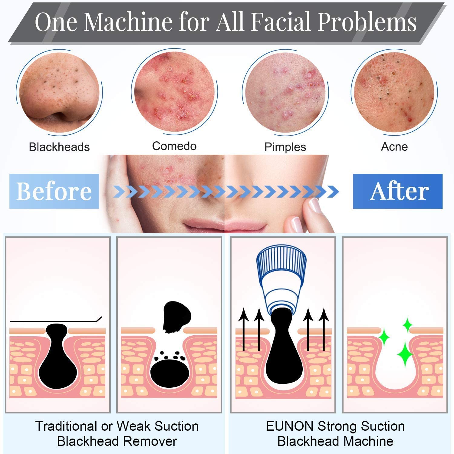 EUNON Blackhead Remover Vacuum Strong Suction Rechargeable Electric