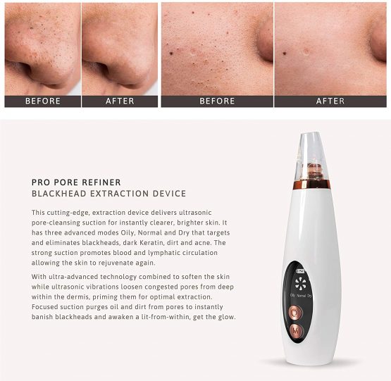 Blackhead Remover Vacuum (UK COMPANY) Vacuum Acne Treatment Pore Vacuum Spot Remover Popping Removal - Image 3