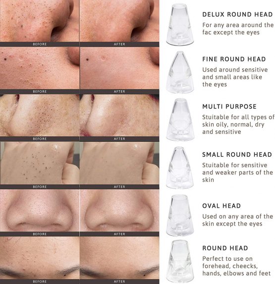 Blackhead Remover Vacuum (UK COMPANY) Vacuum Acne Treatment Pore Vacuum Spot Remover Popping Removal - Image 2