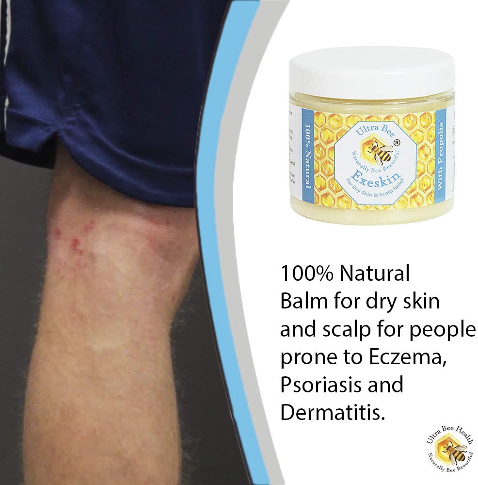 Ultra Bee 100% Natural Exeskin Dry Itchy Skin and Scalp Balm Suitable for People Prone to Eczema Psoriasis,Dermatitis.100ml - Image 2