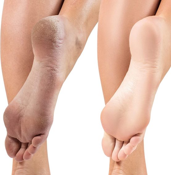 Organic foot soak hard skin foot soak dry feet cracked heels peppermint foot soak organic aloe vera peppermint tea tree oils foaming foot soak remove dry skin feet cracked heels - Image 3